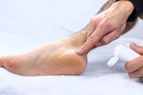 what is the strongest treatment for athlete's foot at home