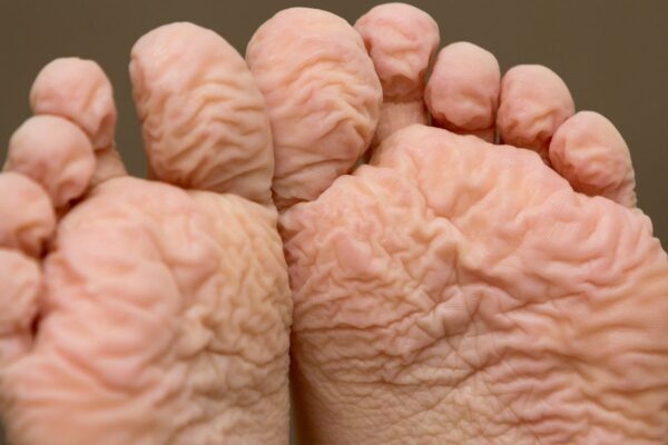 what does athlete's foot look like